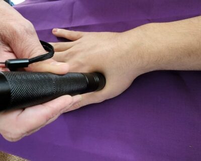 Laser Acupuncture Device - Acupuncture Treatment